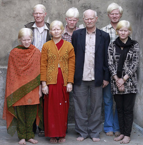 印度奇特家族成世界最大白化病家庭